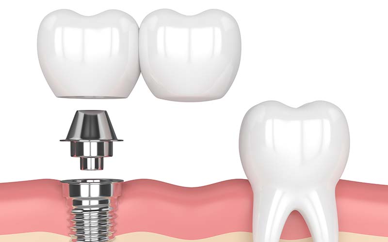 dental-implants-in-woonona