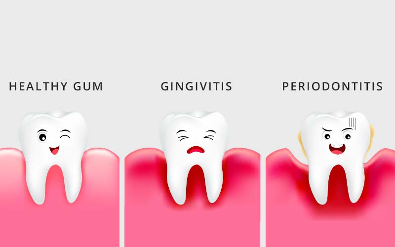 gum-disease-woonona