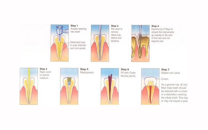 woonona-root-canal