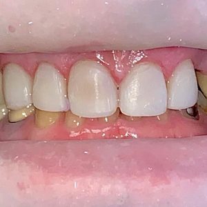 CrownsandBridgeVeneerscombinedwithImplants-After2