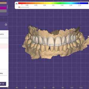 TeethGrinding-Bruxism-4