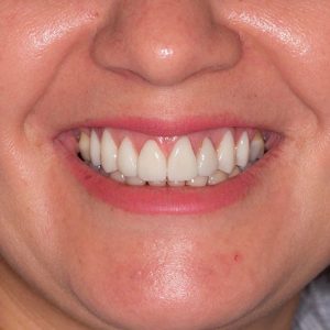 Veneers-after1