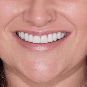 smilemakeover-after1